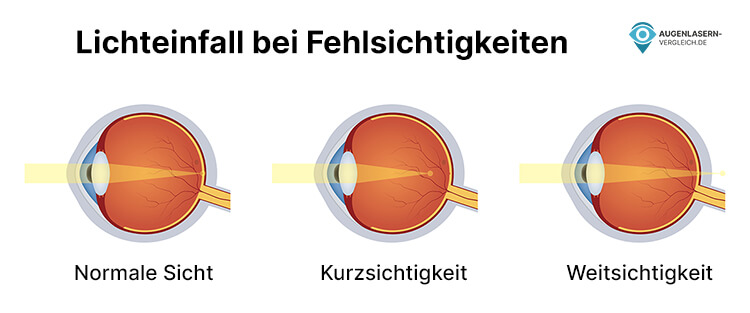 Während bei Menschen ohne Fehlsichtigkeit das Licht auf der Netzhaut gebündelt wird, ist der Lichtpunkt bei kurz- und weitsichtigen Menschen verschoben. Entweder vor- oder hinter die Netzhaut.